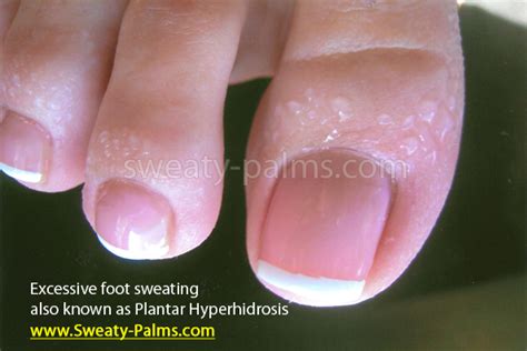 Causes Cure Surgery And Treatments For Hyperhidrosis Of Feet