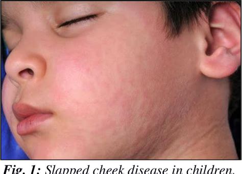 Figure 1 From Slapped Cheek Syndrome Review Semantic Scholar