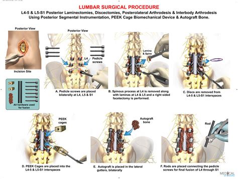 2 Level L4 5 And L5 S1 Posterior Lumbar Interbody Fusion Surgery Lam Medical Art Works