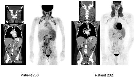 Autoimmune Lymphoproliferative Syndrome Other Imaging Findings Wikidoc