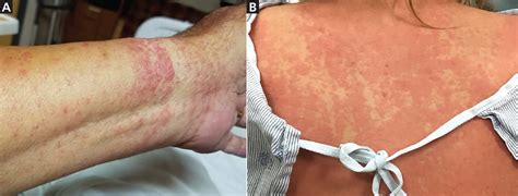 Deadly Drug Rashes Early Recognition And Multidisciplinary Care