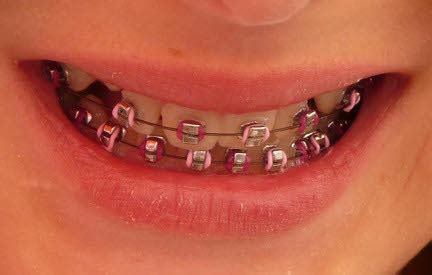 The premier product for senegence ®, lipsense is a patented, amazing departure from conventional lipsticks and lip colors.lipsense is versatile in that you can mix shades to create a number of effects. Colored Braces: What Colors of Braces Can You Get? | Oral Answers