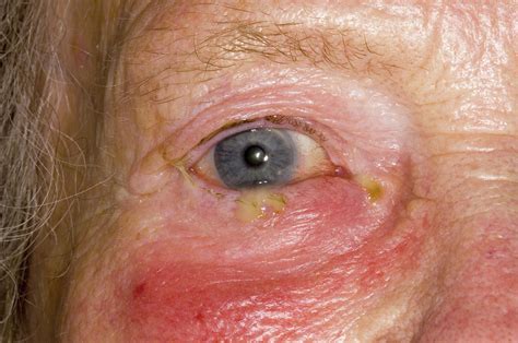 Orbital Cellulitis Photograph By Dr P Marazziscience Photo Library