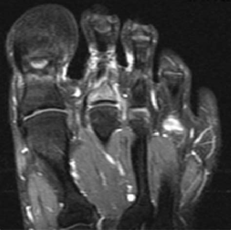 Figure 2 From Mri Changes In Psoriatic Dactylitis Extent Of Pathology