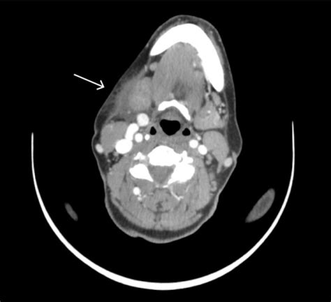 Contrast Ct Scan Of The Neck Showing Right Sided Subman Open I
