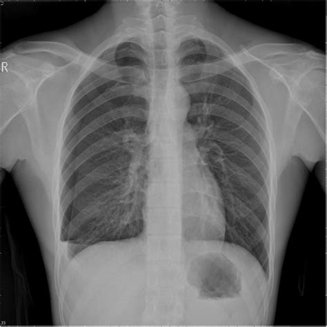 Chest tube insertion for pneumothorax or hematothorax.this video will show you how to insert a chest tube for a pneumothoraxthis patient has multiple rib fra. Unusual case of primary spontaneous hemopneumothorax in a young man with atypical tension ...