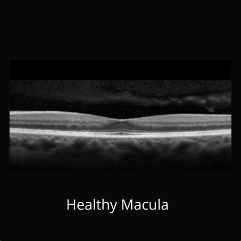 Macular Degeneration Custom Eyecare Newcastle
