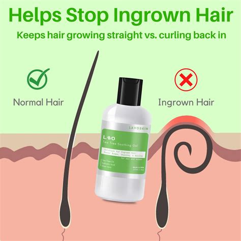 Top 48 Image How To Get Rid Of Ingrown Hair Bumps Vn