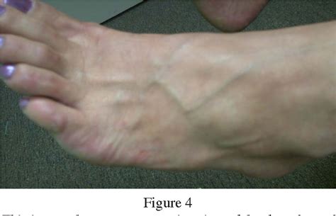 Figure 3 From Ganglion Cyst Of The Foot Treated With Electroacupuncture