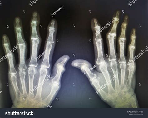 4721 Rheumatic Xray Images Stock Photos And Vectors Shutterstock