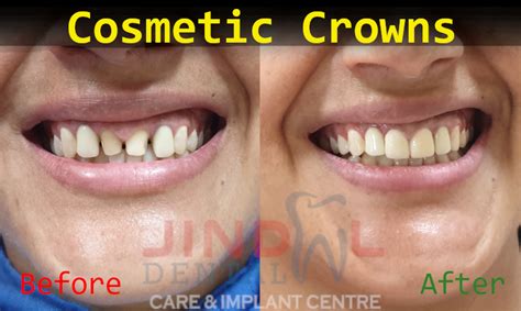 Gallery Jindal Dental Care And Implant Centre