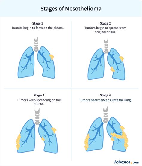 4 Stages Of Mesothelioma Learn About Mesothelioma Staging