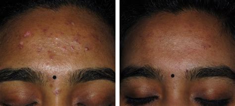 Acne And Acne Scars Before And After Kingsway Dermatology