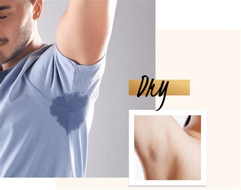 Sweating And Hyperhidrosis Treatment With Miradry At Define Medical