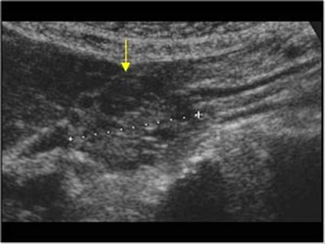 Pancreatic Adenocarcinoma Medical Ultrasound Ultrasound Ultrasound