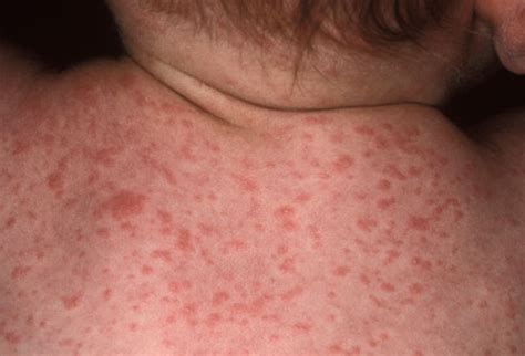 As the fever subsides a rash ( exanthem ) may appear on. Kenali Campak, Rubella Dan Roseola | My story