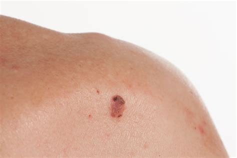 Basal Squamous Cell Skin Cancer