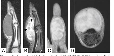 Figure From Mri Findings Of Giant Cell Tumor Of Tendon Sheath And