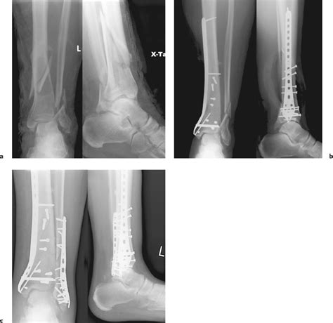 Distal Tibia Fractures Radiology Key Images