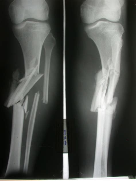 Ncp Close Complete Fracture Fracture Leg Images