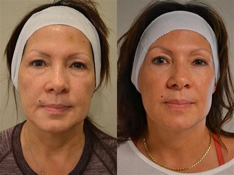 Ultherapy Before After Photos Fresh Face Eye