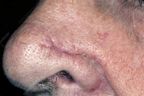 Nose Scar After Skin Cancer Removal Stock Image C0142801 Science