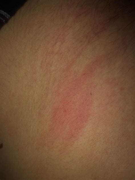 Small Red Dry Patches All Over My Body Slightly Raised Not Itchy Or