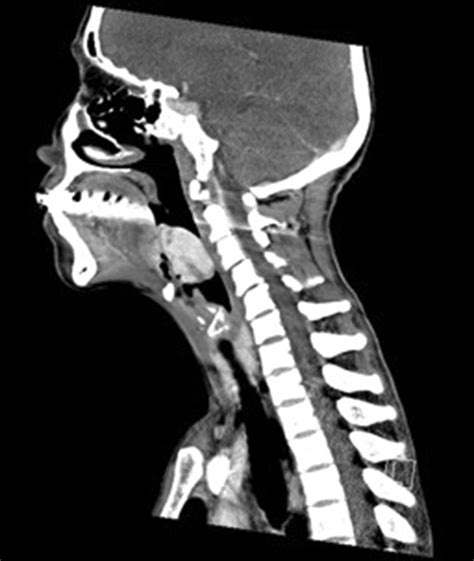 Reformatted Sagittal Ct Images Showing The Mass Protruding Into The