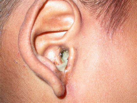 what causes odourless clear discharge from ear healthpulls