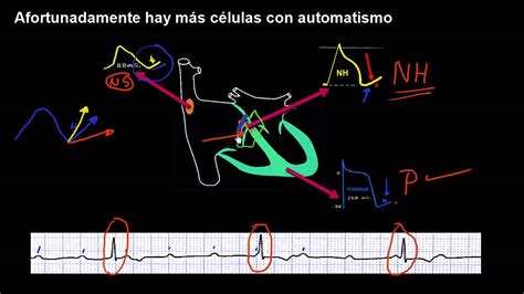 Curso De Electrocardiografia 41 Bloqueo Av Completo Youtube