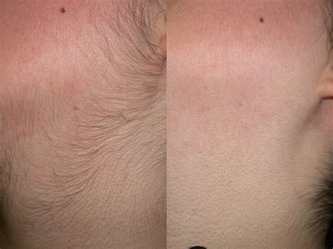 Maybe you would like to learn more about one of these? Eliminar el vello facial