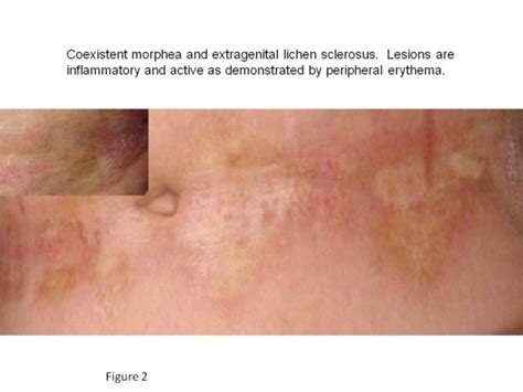 morphea localized scleroderma cancer therapy advisor