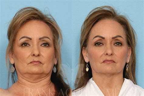 Before And After Photos Liposuction 29 Frank Agullo Md
