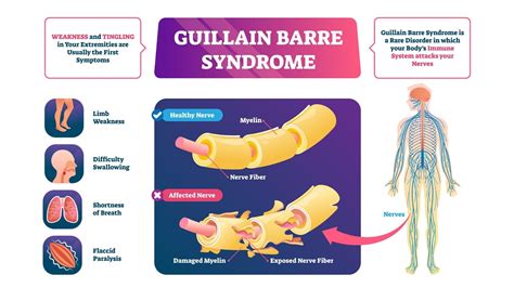 These sensations can quickly spread, eventually paralyzing your whole body. Global Guillain-Barré Syndrome Market 2020 Industry ...