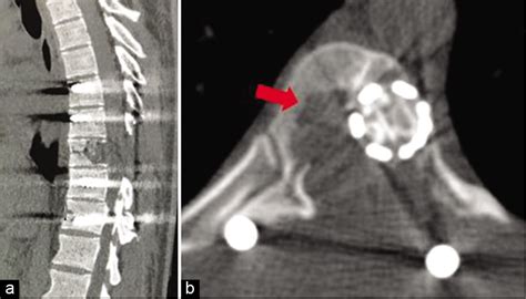 Aneurysmal Bone Cyst Of Thoracic Spine With Neurological Deficit And