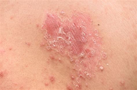 Plaques Rouges Du Visage Perioral Dermatitis Perioral Rash On Face My