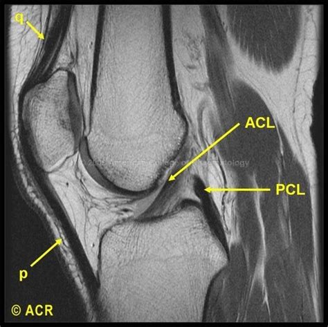Preferred examination mri is the preferred examination for evaluating posterior cruciate ligament (pcl) injuries. mri knee acl. Unidad Especializada en Ortopedia y Traumatologia en Bogota - Colombia PBX ...