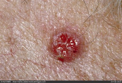 Stock Image Dermatology Basal Cell Carcinoma A Rounded And Raised