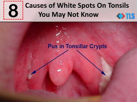 White Bump On Tonsil