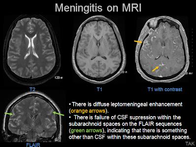 Meningitis is a disease caused by the inflammation of the protective membranes covering the brain and spinal cord known as the meninges. Get Hsv Encephalitis Gross Background - Trend News Power