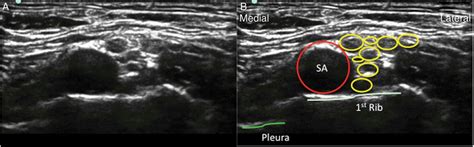 Transverse Ultrasound Image Of Supraclavicular Brachial Plexus Arrow