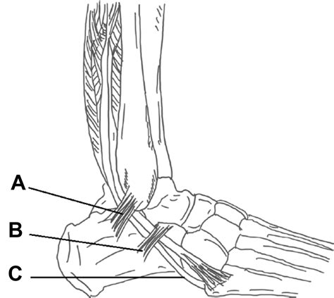 The Role Of Peroneal Tendinopathy And The Cavovarus Foot And Ankle