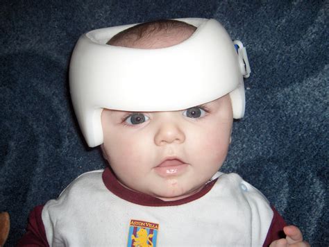 Daniels Little Blog Introduction To Plagiocephaly
