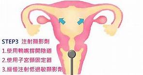【開孕】子宮輸卵管攝影是什麼？輸卵管水腫、輸卵管阻塞一次看｜宏其國際生殖醫學中心