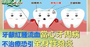 牙齦紅腫流血當心牙周病 不治療恐引全身性發炎 健康2.0