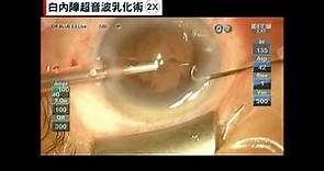 眼科醫學會Live_藍居福-白內障超音波乳化術