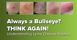 Think the Lyme Disease Rash is Always a Bull's-eye? Think Again! | Johns Hopkins Rheumatology
