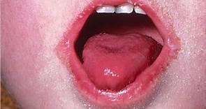 What is scarlet fever?