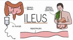Understanding Ileus (Paralytic Ileus)