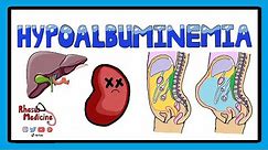Hypoalbuminemia - Functions of Albumin in the Body + Pathophysiology of Hypoalbuminemia